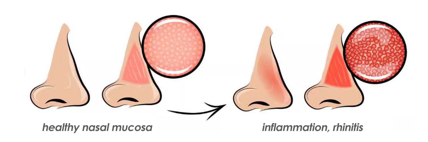 Alleviating Allergic Rhinitis Through Air Purifiers